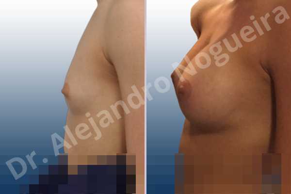 Empty breasts,Lateral breasts,Narrow breasts,Skinny breasts,Small breasts,Too far apart wide cleavage breasts,Anatomical shape,Circumareolar incision,Subfascial pocket plane - photo 2