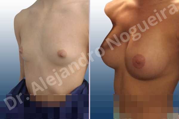 Empty breasts,Lateral breasts,Narrow breasts,Skinny breasts,Small breasts,Too far apart wide cleavage breasts,Anatomical shape,Circumareolar incision,Subfascial pocket plane - photo 3