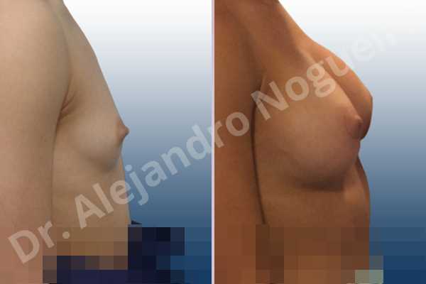 Empty breasts,Lateral breasts,Narrow breasts,Skinny breasts,Small breasts,Too far apart wide cleavage breasts,Anatomical shape,Circumareolar incision,Subfascial pocket plane - photo 4