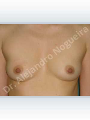 Narrow breasts,Skinny breasts,Anatomical shape,Lower hemi periareolar incision,Subfascial pocket plane