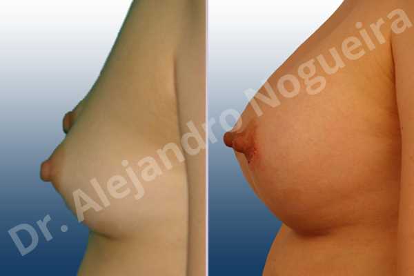 Narrow breasts,Skinny breasts,Anatomical shape,Lower hemi periareolar incision,Subfascial pocket plane - photo 2