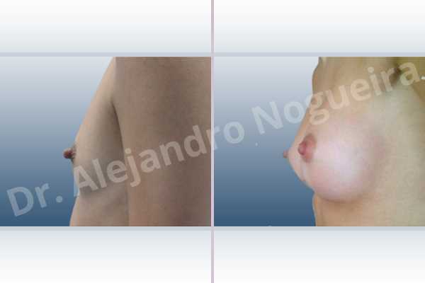 Cross eyed breasts,Empty breasts,Lateral breasts,Narrow breasts,Skinny breasts,Small breasts,Anatomical shape,Inframammary incision,Subfascial pocket plane - photo 2