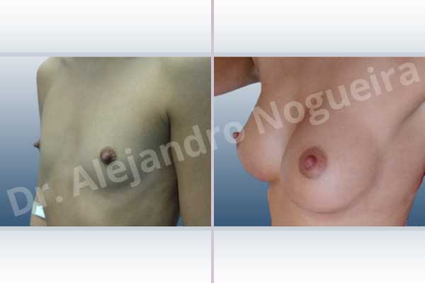 Cross eyed breasts,Empty breasts,Lateral breasts,Narrow breasts,Skinny breasts,Small breasts,Anatomical shape,Inframammary incision,Subfascial pocket plane - photo 3