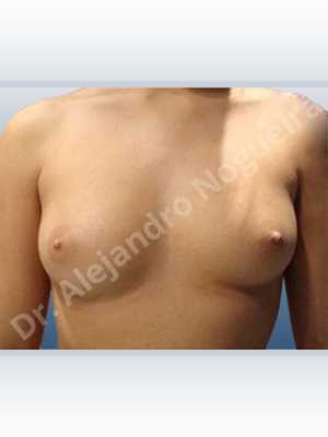 Narrow breasts,Slightly large breasts,Custom made size and shape,Lower hemi periareolar incision,Round shape,Subfascial pocket plane,Extra large size