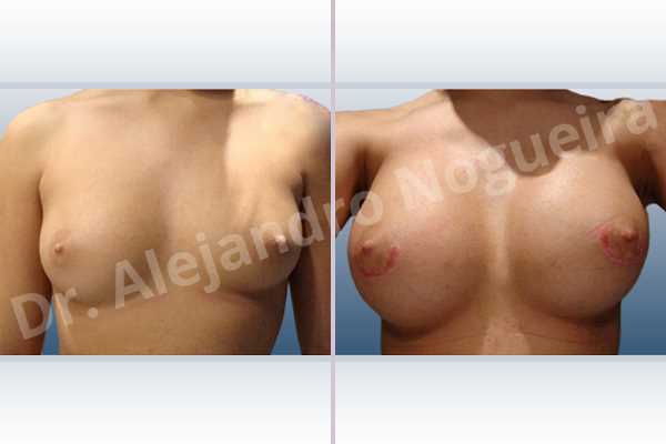 Narrow breasts,Slightly large breasts,Custom made size and shape,Lower hemi periareolar incision,Round shape,Subfascial pocket plane,Extra large size - photo 1