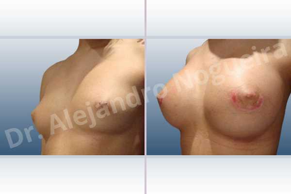 Narrow breasts,Slightly large breasts,Custom made size and shape,Lower hemi periareolar incision,Round shape,Subfascial pocket plane,Extra large size - photo 3