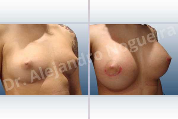 Narrow breasts,Slightly large breasts,Custom made size and shape,Lower hemi periareolar incision,Round shape,Subfascial pocket plane,Extra large size - photo 5