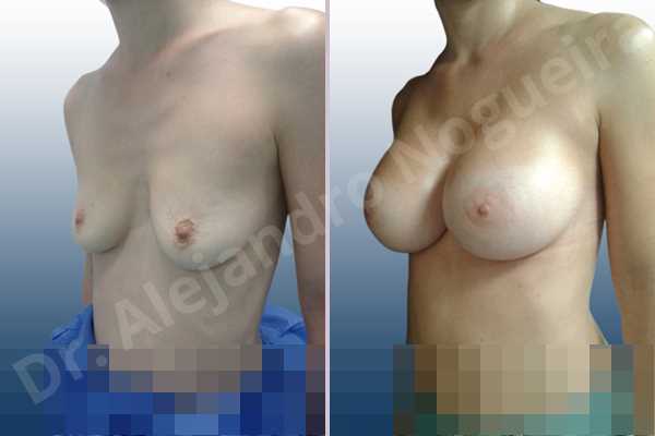 Empty breasts,Mildly saggy droopy breasts,Narrow breasts,Pendulous breasts,Skinny breasts,Sunken chest,Small breasts,Anatomical shape,Extra large size,Lower hemi periareolar incision,Subfascial pocket plane - photo 3