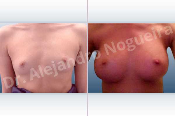 Asymmetric breasts,Empty breasts,Lateral breasts,Narrow breasts,Skinny breasts,Small breasts,Too far apart wide cleavage breasts,Anatomical shape,Inframammary incision,Subfascial pocket plane - photo 1