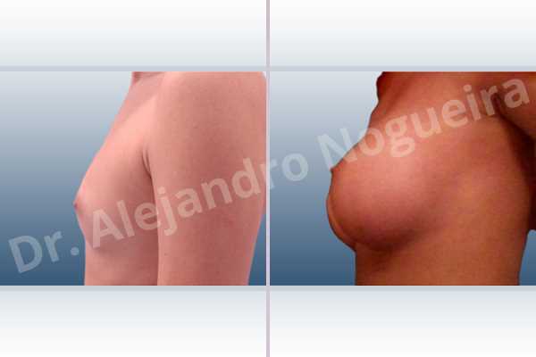 Asymmetric breasts,Empty breasts,Lateral breasts,Narrow breasts,Skinny breasts,Small breasts,Too far apart wide cleavage breasts,Anatomical shape,Inframammary incision,Subfascial pocket plane - photo 2