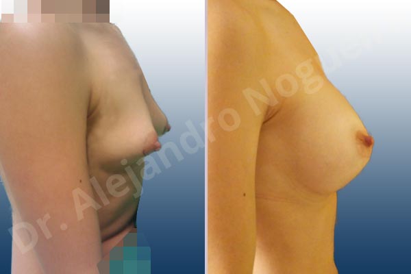 Before & After Case EXNFEMB7