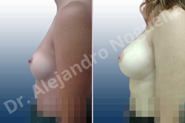Asymmetric breasts,Empty breasts,Small breasts,Anatomical shape,Inframammary incision,Subfascial pocket plane - photo 2