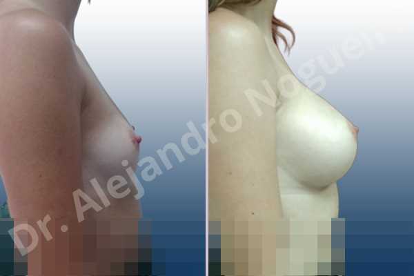 Asymmetric breasts,Empty breasts,Small breasts,Anatomical shape,Inframammary incision,Subfascial pocket plane - photo 4
