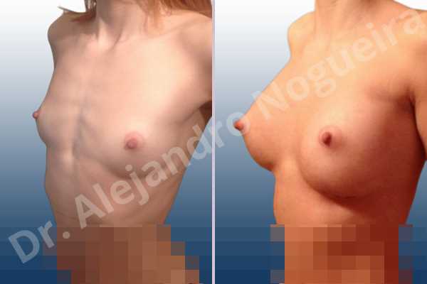 Asymmetric breasts,Cross eyed breasts,Empty breasts,Lateral breasts,Narrow breasts,Pigeon chest,Skinny breasts,Small breasts,Too far apart wide cleavage breasts,Anatomical shape,Extra large size,Inframammary incision,Subfascial pocket plane - photo 4