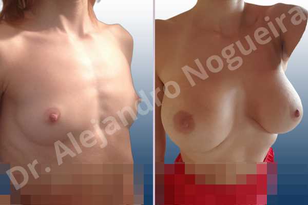 Asymmetric breasts,Cross eyed breasts,Empty breasts,Lateral breasts,Narrow breasts,Pigeon chest,Skinny breasts,Small breasts,Too far apart wide cleavage breasts,Anatomical shape,Extra large size,Inframammary incision,Subfascial pocket plane - photo 7