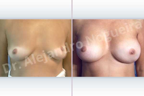 Asymmetric breasts,Cross eyed breasts,Empty breasts,Lateral breasts,Pigeon chest,Slightly saggy droopy breasts,Small breasts,Sunken chest,Too far apart wide cleavage breasts,Wide breasts,Anatomical shape,Inframammary incision,Subfascial pocket plane - photo 1