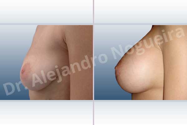 Empty breasts,Lateral breasts,Moderately large breasts,Moderately saggy droopy breasts,Pendulous breasts,Severely saggy droopy breasts,Skinny breasts,Slightly large breasts,Too far apart wide cleavage breasts,Anatomical shape,Extra large size,Lower hemi periareolar incision,Subfascial pocket plane - photo 2