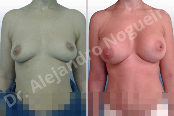 Asymmetric breasts,Cross eyed breasts,Empty breasts,Large areolas,Lateral breasts,Moderately saggy droopy breasts,Pendulous breasts,Pigeon chest,Small breasts,Too far apart wide cleavage breasts,Anatomical shape,Lower hemi periareolar incision,Subfascial pocket plane - photo 1