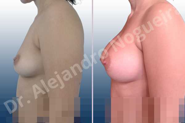 Asymmetric breasts,Cross eyed breasts,Empty breasts,Large areolas,Lateral breasts,Moderately saggy droopy breasts,Pendulous breasts,Pigeon chest,Small breasts,Too far apart wide cleavage breasts,Anatomical shape,Lower hemi periareolar incision,Subfascial pocket plane - photo 2