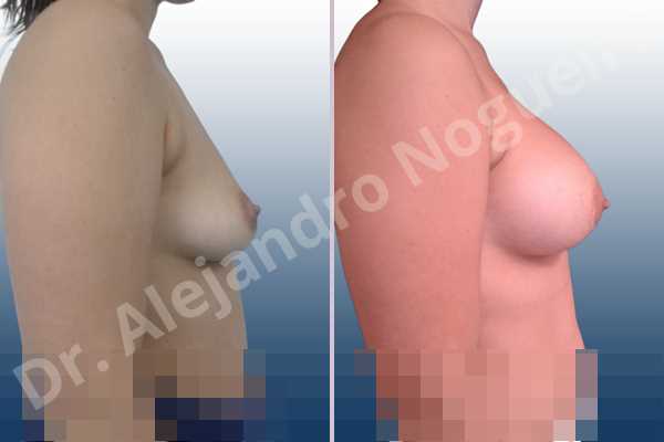 Asymmetric breasts,Cross eyed breasts,Empty breasts,Large areolas,Lateral breasts,Moderately saggy droopy breasts,Pendulous breasts,Pigeon chest,Small breasts,Too far apart wide cleavage breasts,Anatomical shape,Lower hemi periareolar incision,Subfascial pocket plane - photo 4