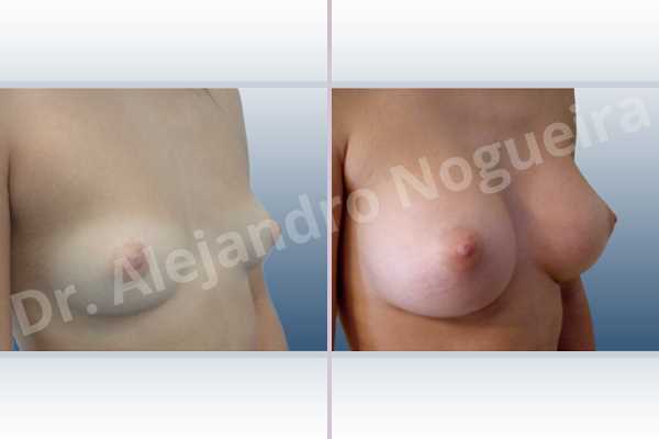 Cleft nipples,Cross eyed breasts,Cross eyed breasts implants,Empty breasts,Inverted nipples,Lateral breasts,Narrow breasts,Skinny breasts,Sunken chest,Too far apart wide cleavage breast implants,Too far apart wide cleavage breasts,Anatomical shape,Inframammary incision,Subfascial pocket plane - photo 5
