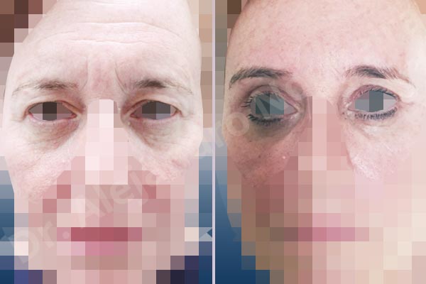 Baggy lower eyelids,Baggy upper eyelids,Deep nasolabial folds,Droopy cheeks,Droopy eyebrows,Droopy face,Droopy forehead,Saggy upper eyelids,Upper eyelids ptosis,Lower eyelid fat bags resection,Short temporal incisions supraperiosteal extended lift of the upper two thirds of the face,Transconjunctival approach incision,Upper eyelid fat bags resection,Upper eyelid skin and muscle resection - photo 1
