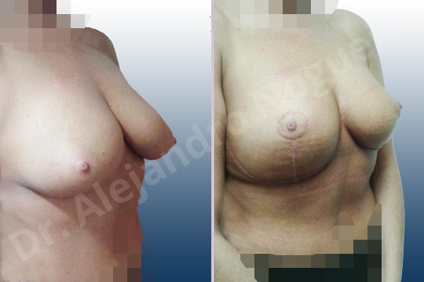 Cross eyed breasts,Lateral breasts,Moderately saggy droopy breasts,Too far apart wide cleavage breasts,Tuberous breasts,Wide breasts,Custom made size and shape,Lollipop incision,Superior pedicle - photo 5