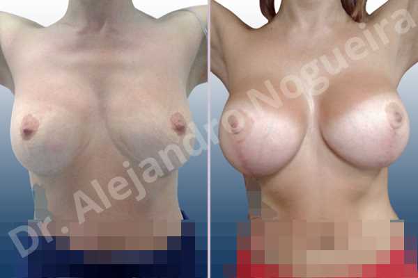 Asymmetric breasts,Breast tissue bottoming out,Cross eyed breasts,Empty breasts,Failed breast reduction,Moderately saggy droopy breasts,Pendulous breasts,Pigeon chest,Slightly saggy droopy breasts,Small breasts,Wide scars,Anatomical shape,Anchor incision,Custom incision,Extra large size,Subfascial pocket plane - photo 2