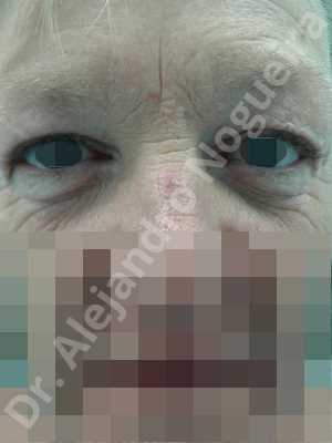 Baggy lower eyelids,Baggy upper eyelids,Saggy lower eyelids,Saggy upper eyelids,Upper eyelids ptosis,Lower eyelid fat bags resection,Lower eyelid skin and muscle resection,Subciliary approach incision,Upper eyelid fat bags resection,Upper eyelid skin and muscle resection