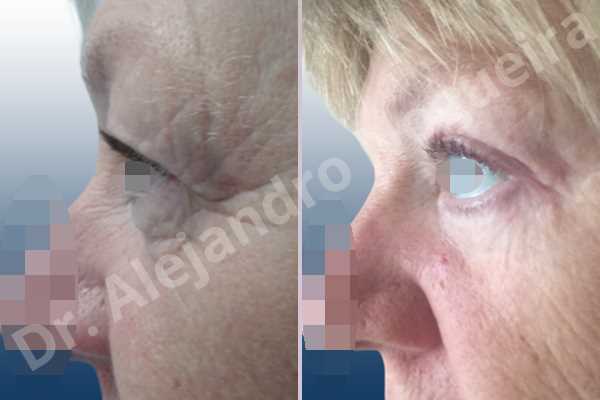 Baggy lower eyelids,Baggy upper eyelids,Saggy lower eyelids,Saggy upper eyelids,Upper eyelids ptosis,Lower eyelid fat bags resection,Lower eyelid skin and muscle resection,Subciliary approach incision,Upper eyelid fat bags resection,Upper eyelid skin and muscle resection - photo 2