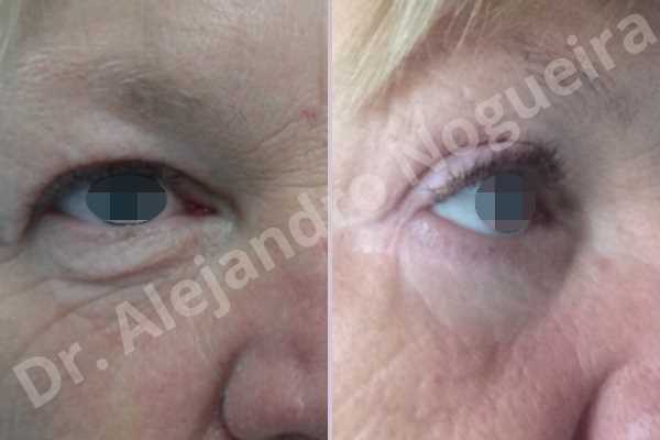 Baggy lower eyelids,Baggy upper eyelids,Saggy lower eyelids,Saggy upper eyelids,Upper eyelids ptosis,Lower eyelid fat bags resection,Lower eyelid skin and muscle resection,Subciliary approach incision,Upper eyelid fat bags resection,Upper eyelid skin and muscle resection - photo 5