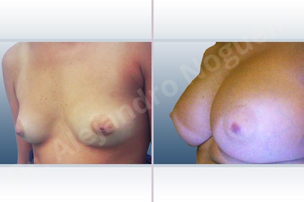 Asymmetric breasts,Cleft nipples,Empty breasts,Inverted nipples,Narrow breasts,Small breasts,Sunken chest,Anatomical shape,Extra large size,Subfascial pocket plane,Inframammary incision - photo 3
