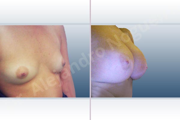 Asymmetric breasts,Cleft nipples,Empty breasts,Inverted nipples,Narrow breasts,Small breasts,Sunken chest,Anatomical shape,Extra large size,Subfascial pocket plane,Inframammary incision - photo 5