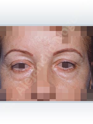 Baggy lower eyelids,Baggy upper eyelids,Saggy upper eyelids,Upper eyelids ptosis,Lower eyelid fat bags resection,Transconjunctival approach incision,Upper eyelid fat bags resection,Upper eyelid skin and muscle resection