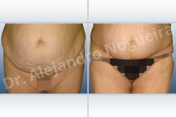 Saggy abdomen,Weak abdomen muscles,Panniculectomy - photo 1