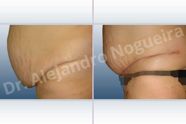 Saggy abdomen,Weak abdomen muscles,Panniculectomy - photo 2