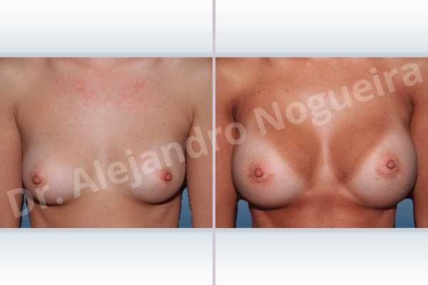 Cross eyed breasts,Narrow breasts,Skinny breasts,Small breasts,Anatomical shape,Lower hemi periareolar incision,Subfascial pocket plane - photo 1