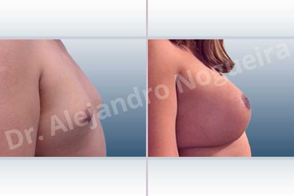 Asymmetric breasts,Cross eyed breasts,Empty breasts,Lateral breasts,Small breasts,Too far apart wide cleavage breasts,Transgender breasts,Wide breasts,Anatomical shape,Extra large size,Inframammary incision,Subfascial pocket plane - photo 4