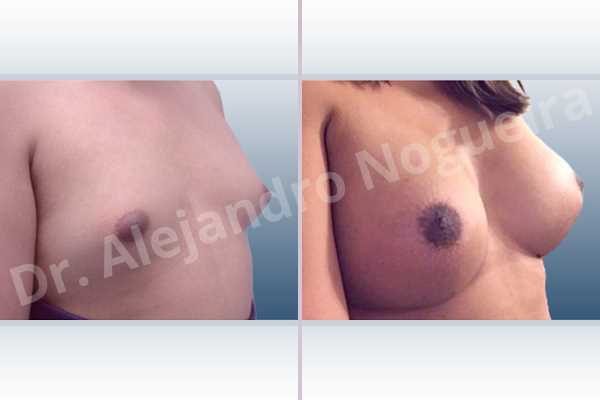 Asymmetric breasts,Cross eyed breasts,Empty breasts,Lateral breasts,Small breasts,Too far apart wide cleavage breasts,Transgender breasts,Wide breasts,Anatomical shape,Extra large size,Inframammary incision,Subfascial pocket plane - photo 5