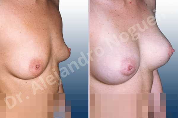 Empty breasts,Lateral breasts,Skinny breasts,Slightly saggy droopy breasts,Small breasts,Sunken chest,Too far apart wide cleavage breasts,Anatomical shape,Lower hemi periareolar incision,Subfascial pocket plane - photo 2