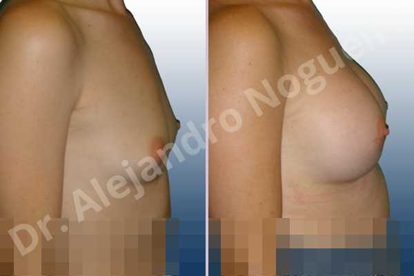 Lateral breasts,Skinny breasts,Small breasts,Too far apart wide cleavage breasts,Anatomical shape,Lower hemi periareolar incision,Subfascial pocket plane - photo 4