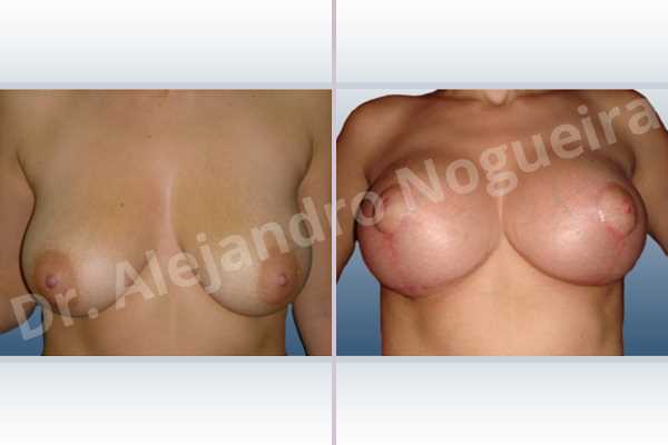 Empty breasts,Mildly saggy droopy breasts,Slightly large breasts,Anatomical shape,Anchor incision,Subfascial pocket plane,Superior pedicle - photo 1