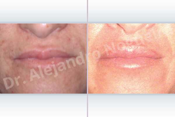Small lips,Upper lip autologous dermis collagen filler - photo 3