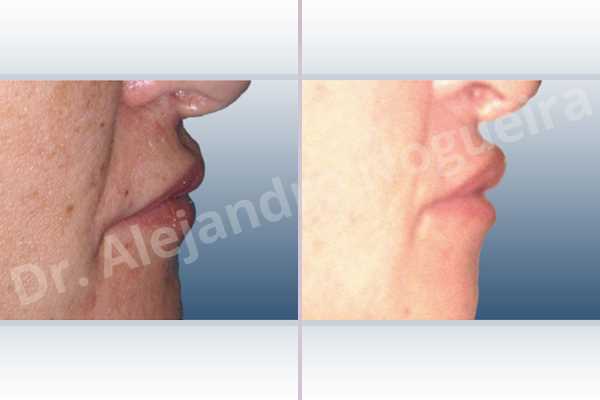 Small lips,Upper lip autologous dermis collagen filler - photo 4