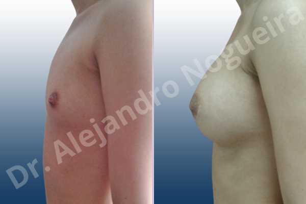 Asymmetric breasts,Empty breasts,Narrow breasts,Skinny breasts,Small breasts,Sunken chest,Anatomical shape,Lower hemi periareolar incision,Subfascial pocket plane - photo 2