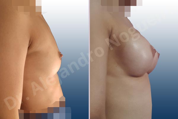Asymmetric breasts,Empty breasts,Narrow breasts,Skinny breasts,Small breasts,Extra large size,Inframammary incision,Round shape,Subfascial pocket plane - photo 4
