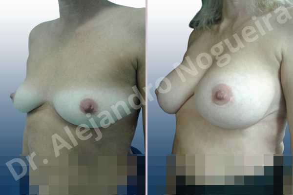 Asymmetric breasts,Cross eyed breasts,Empty breasts,Lateral breasts,Mildly saggy droopy breasts,Small breasts,Too far apart wide cleavage breasts,Wide breasts,Anatomical shape,Inframammary incision,Subfascial pocket plane - photo 3