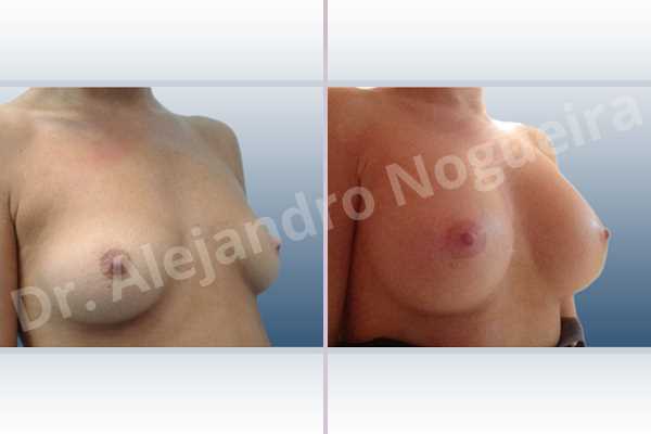 Asymmetric breasts,Empty breasts,Lateral breasts,Pigeon chest,Slightly saggy droopy breasts,Small breasts,Too far apart wide cleavage breasts,Wide breasts,Anatomical shape,Inframammary incision,Subfascial pocket plane - photo 5