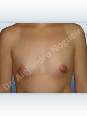 Asymmetric breasts,Cross eyed breasts,Narrow breasts,Small breasts,Tuberous breasts,Lower hemi periareolar incision,Round shape,Subfascial pocket plane,Tuberous mammoplasty