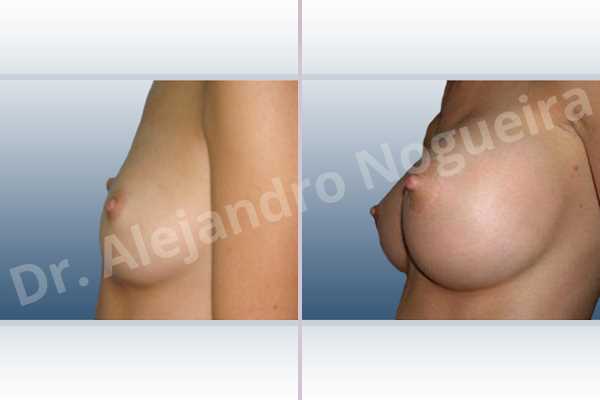 Asymmetric breasts,Cross eyed breasts,Lateral breasts,Skinny breasts,Too far apart wide cleavage breasts,Anatomical shape,Extra large size,Lower hemi periareolar incision,Subfascial pocket plane - photo 2